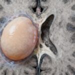 Fatigue et tumeur cérébrale : quand s'inquiéter sans aucun texte