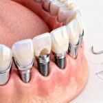 Comprendre le pont dentaire : définition, types et entretien sans aucun texte