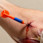 Nerf coincé dans le bras : symptômes, causes et traitements sans aucun texte